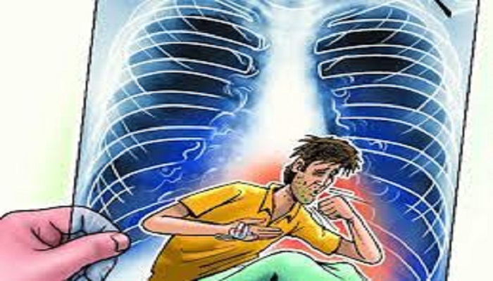 योगी सरकार इस साल 6.50 लाख टीबी मरीजों का कराएगी नोटिफिकेशन