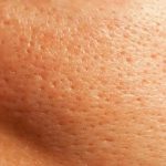 ओपन पोर्स की है समस्या, आजमाएं ये घरेलू टिप्स
