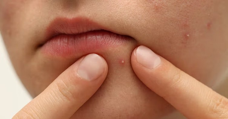 पिंपल से छुटकारा पाने के लिए इस्तेमाल करें ये फेस पैक