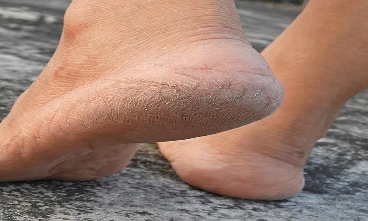 फटी एड़ियों बनेंगी सॉफ्ट, इस पैक का करें इस्तेमाल